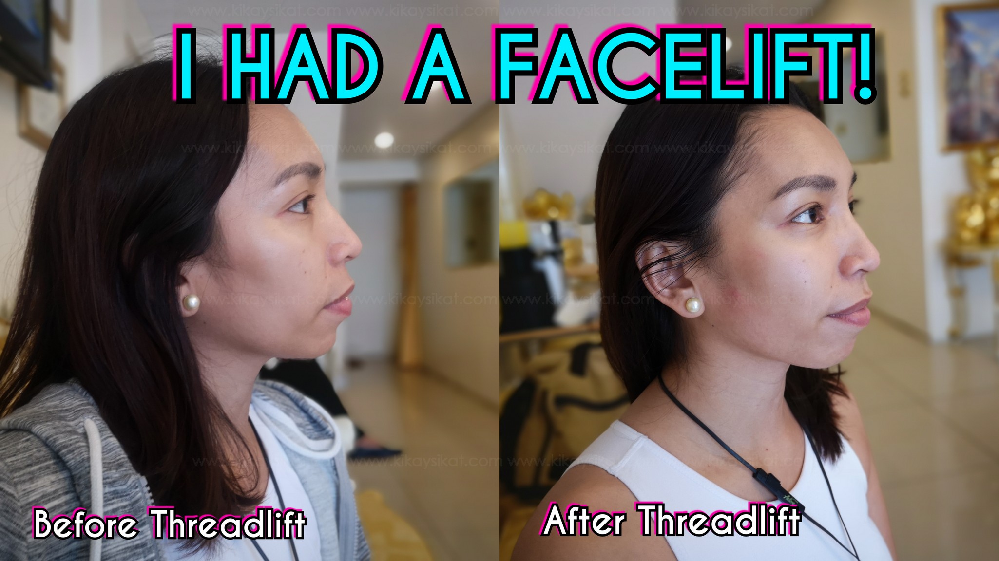 thread-lift-before-after-face-lift-9